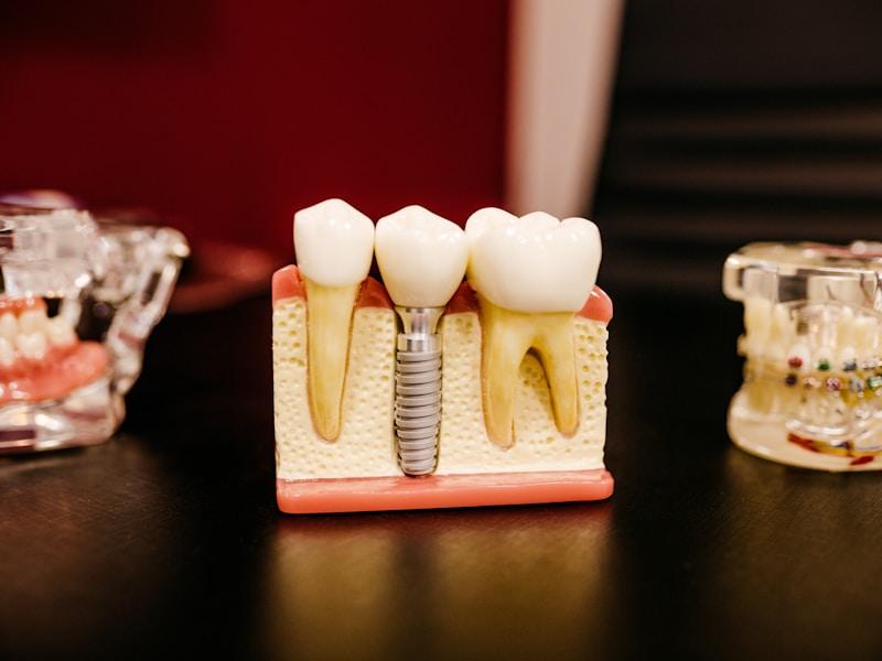 Dental implant model showing titanium post and crown