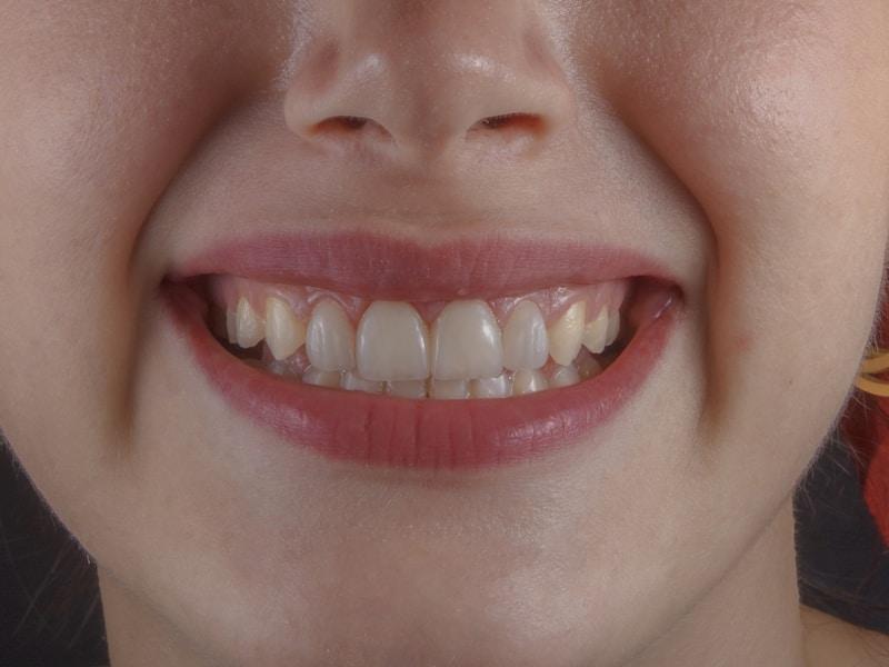 Professional teeth whitening treatment in Peshawar